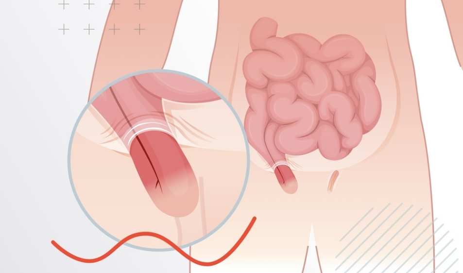 best inguinal hernia specialist in pune